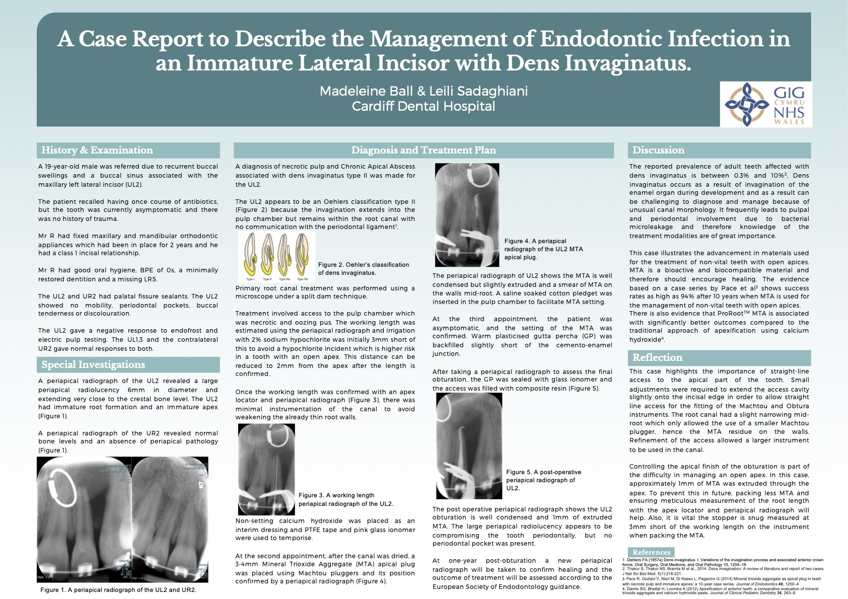 Poster A case report to describe the management of endodontic infection in an immature lateral incisor with dens invaginatus.