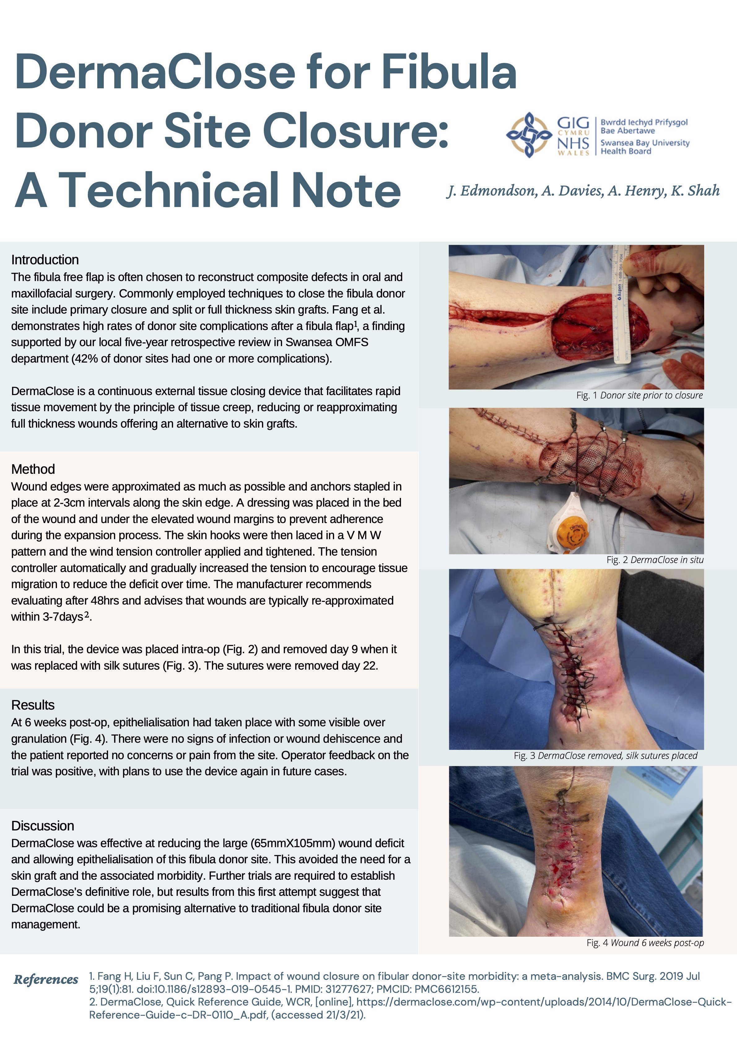 Poster DermaClose for fibula donor site closure: A Technical Note